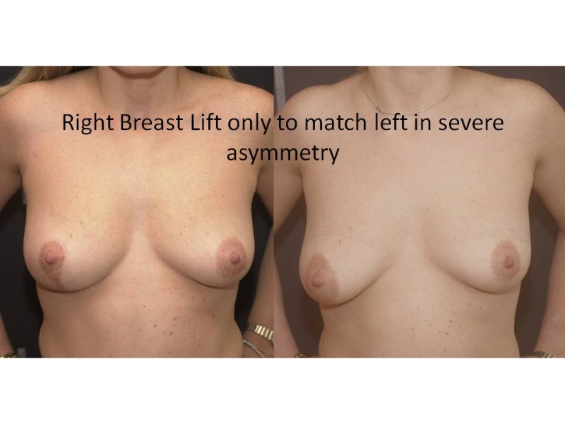 Breast Reduction Surgery