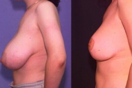 Breast Reduction Surgery