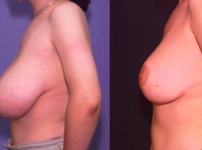 Breast Reduction Surgery