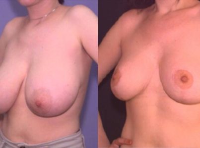 Breast Reduction Surgery