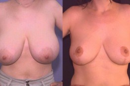 Breast Reduction Surgery