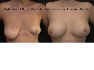 Breast Reduction Surgery