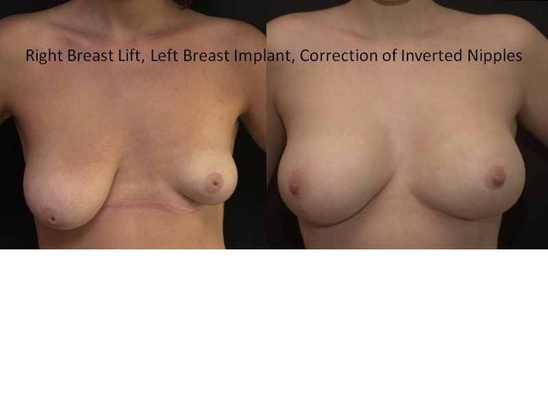 Breast Reduction Surgery