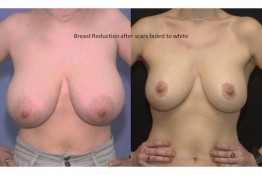 Breast Reduction Surgery