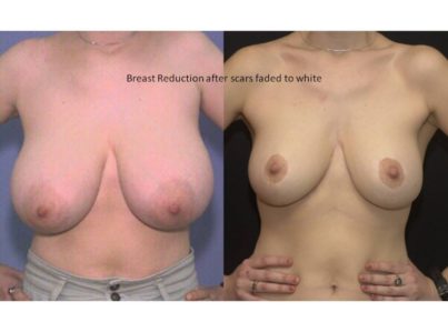 Breast Reduction Surgery