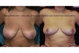 Breast Reduction Surgery