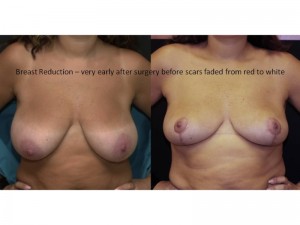 Breast Reduction Surgery