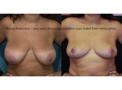 Breast Reduction Surgery