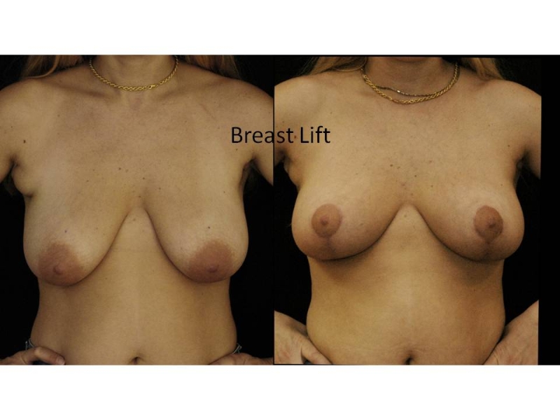 Breast Reduction Surgery