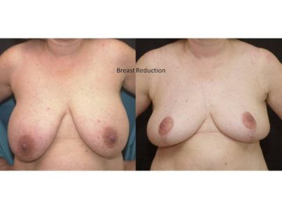 breast-reduction8