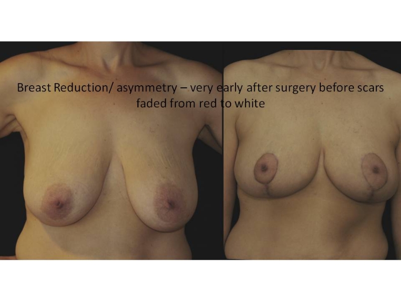 Breast Reduction Surgery