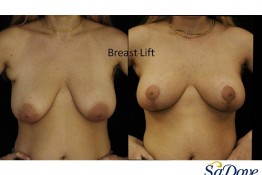 Breast Lift Surgery