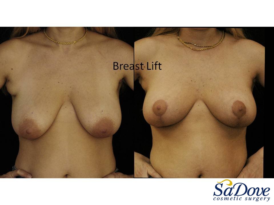 Breast Lift Surgery