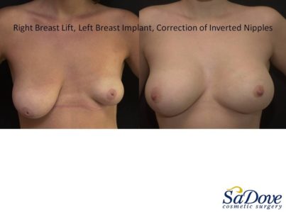 Breast Lift Surgery