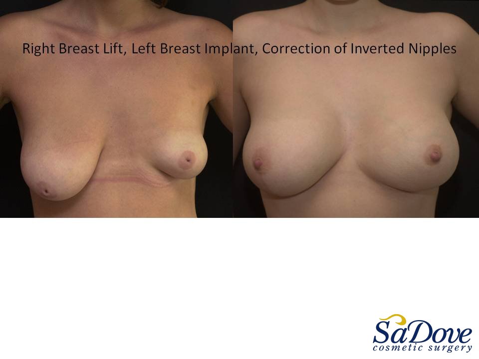 Breast Lift Surgery