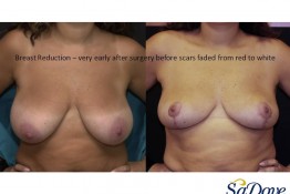 Breast Lift Surgery