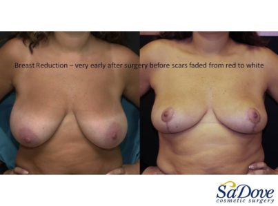 Breast Lift Surgery