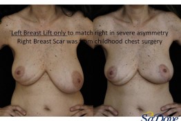 Breast Lift Surgery