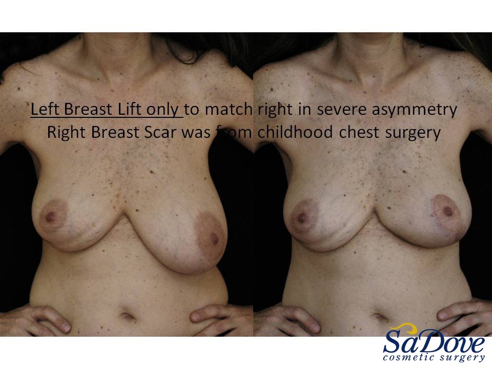 Breast Lift Surgery