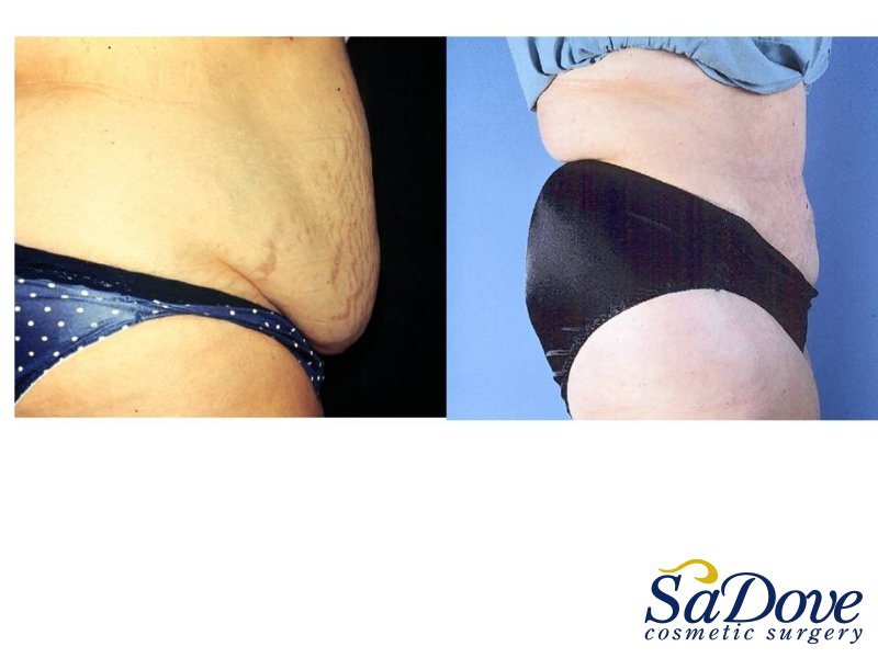 Abdominoplasty Surgery