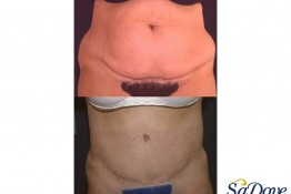 Abdominoplasty Surgery