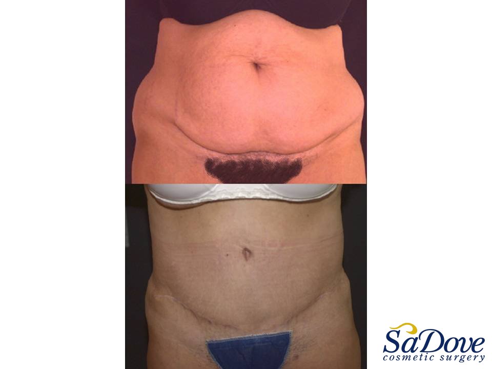 Abdominoplasty Surgery