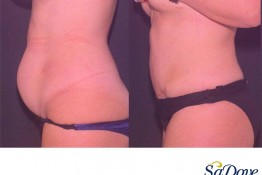 Abdominoplasty Surgery