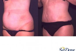 Abdominoplasty Surgery