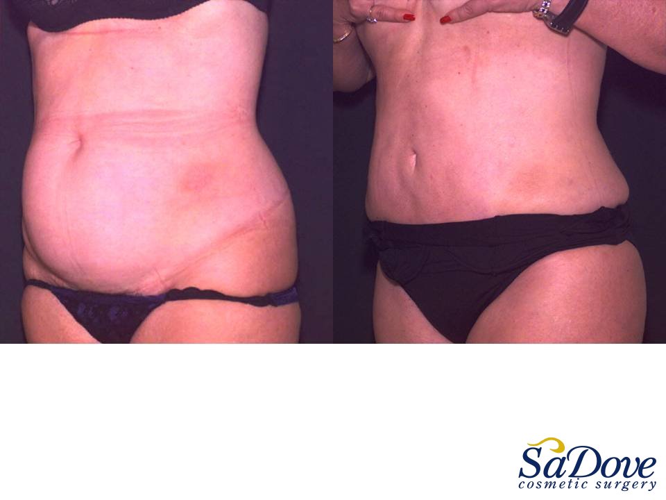 Abdominoplasty Surgery