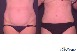 Abdominoplasty Surgery