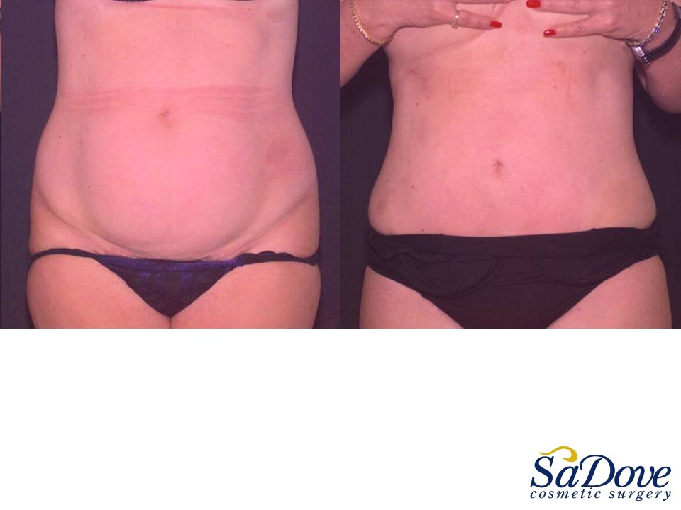 Abdominoplasty Surgery