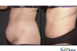 Abdominoplasty Surgery