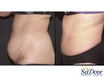 Abdominoplasty Surgery