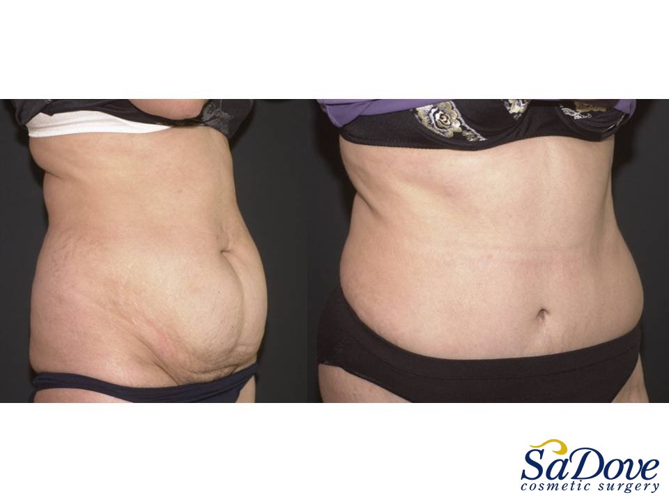 Abdominoplasty Surgery