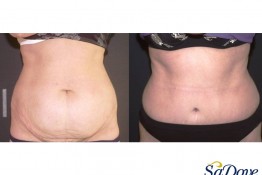 Abdominoplasty Surgery