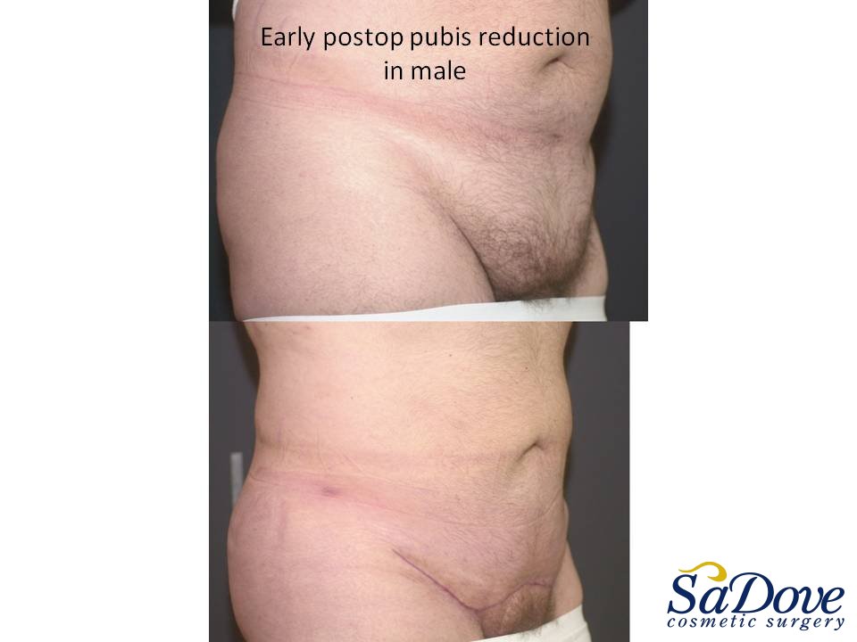 Abdominoplasty Surgery