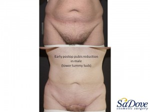 Abdominoplasty Surgery
