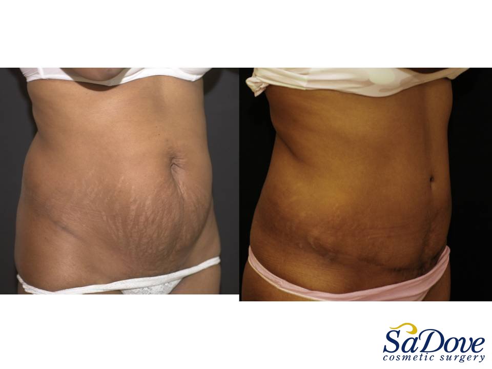 Abdominoplasty Surgery