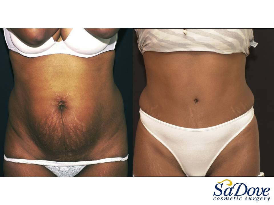 Abdominoplasty Surgery