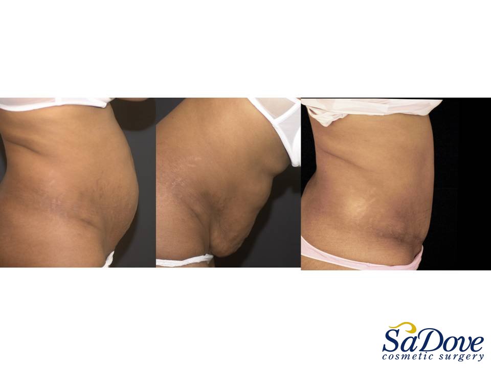 Abdominoplasty Surgery