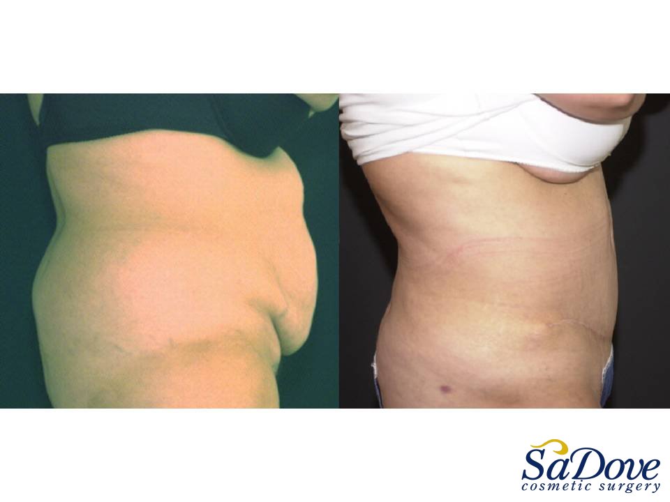 Abdominoplasty Surgery