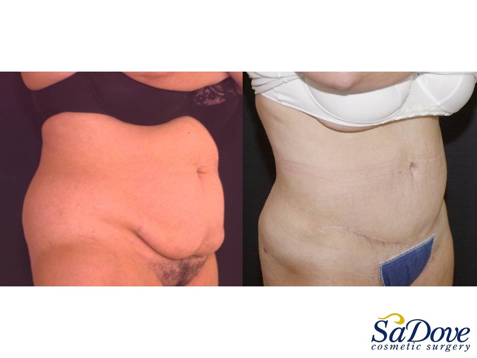 Abdominoplasty Surgery