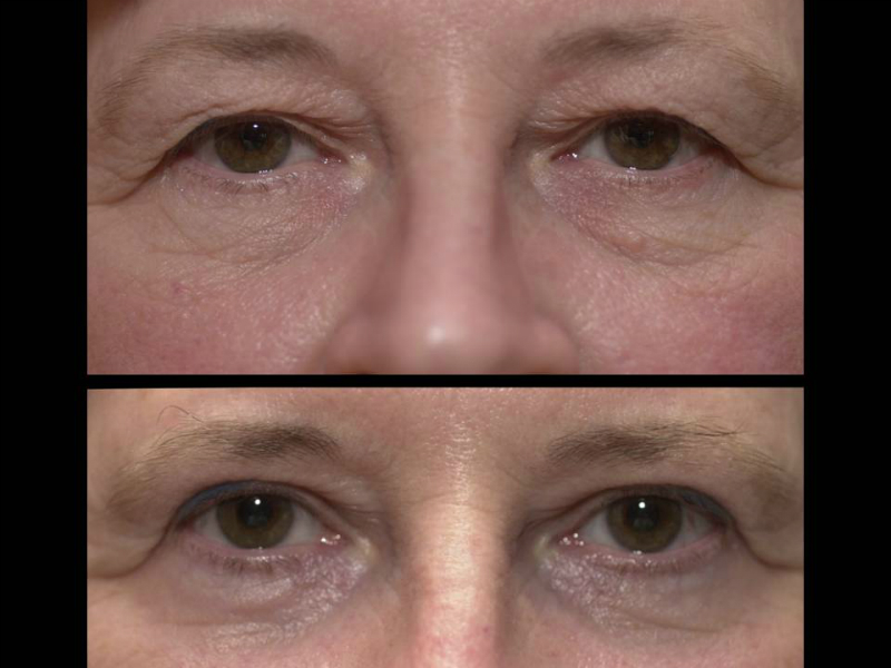 Laser Skin Resurfacing Surgery