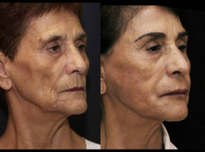 Laser Skin Resurfacing Surgery