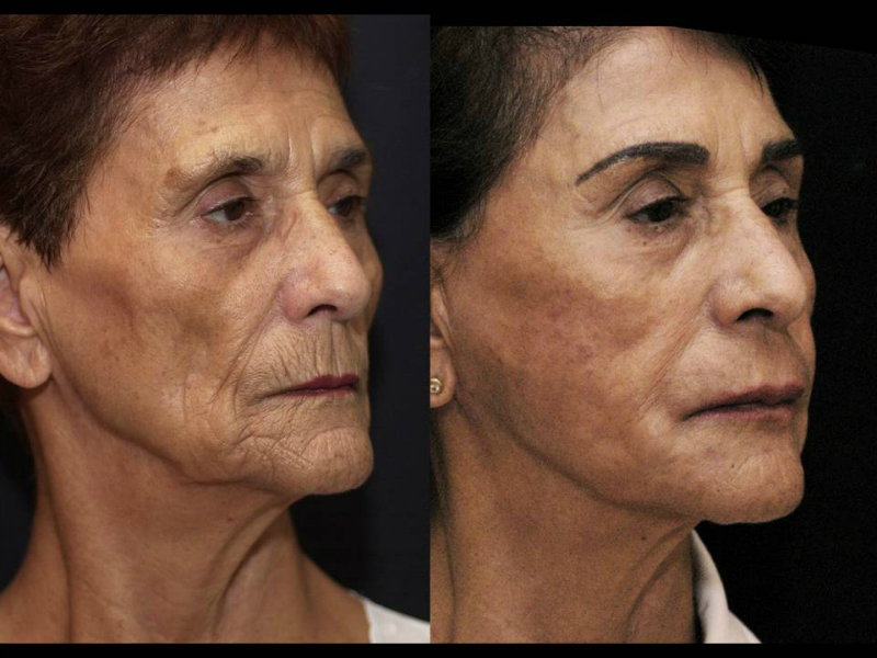 Laser Skin Resurfacing Surgery