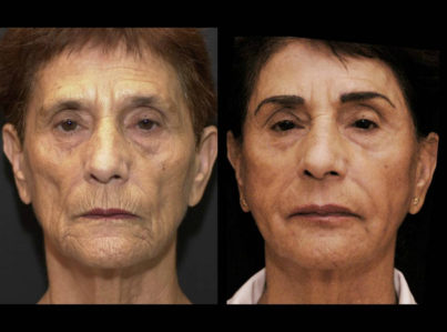 Laser Skin Resurfacing Surgery