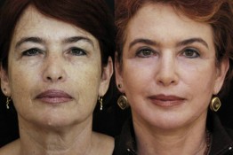 Laser Skin Resurfacing Surgery