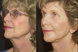 Laser Skin Resurfacing Surgery