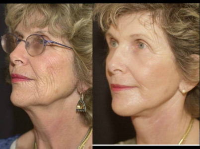 Laser Skin Resurfacing Surgery