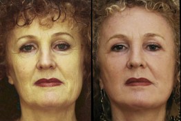 Laser Skin Resurfacing Surgery